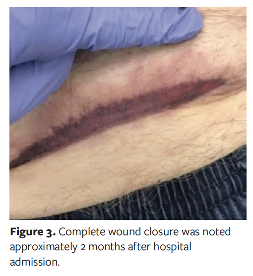 Use of Negative Pressure Wound Therapy to Successfully Treat